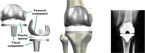 Dr. Mavlankar - TKR, Total Knee Replacement, Arthroscopic Surgery ...